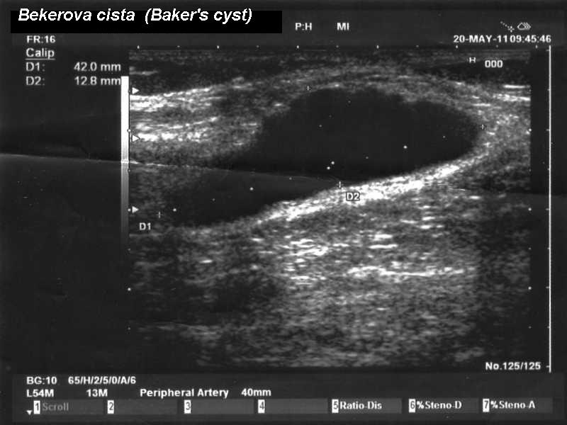 Ultrasound example of a Baker’s cyst behind the knee with measurement markers.