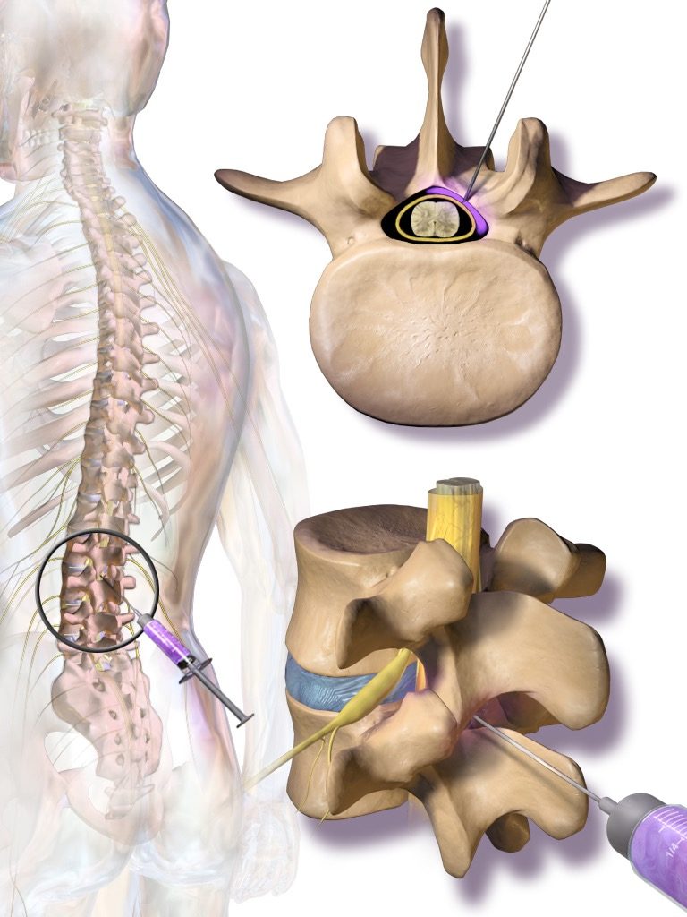 Epidural Steroid Injection vs Surgery