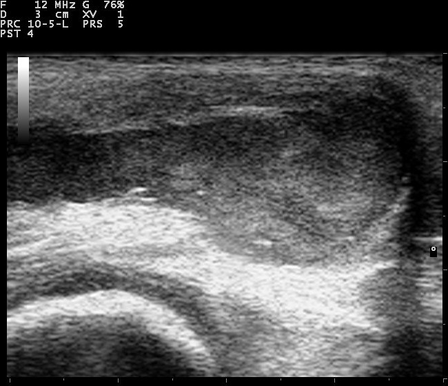 Ultrasound example showing fluid within a knee joint.