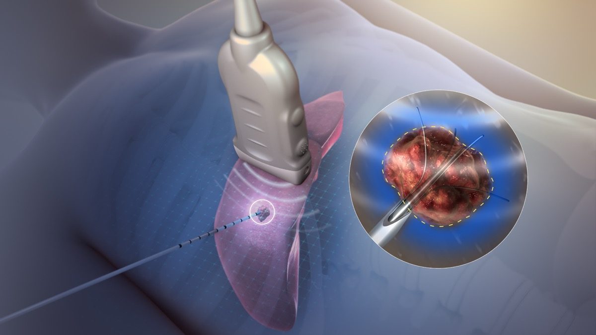 Radiofrequency ablation needle placement near spinal facet joint