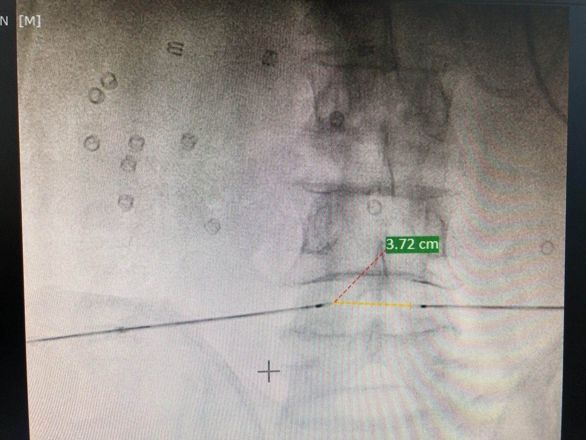 Intradiscal RFA-Biacuplasty procedure