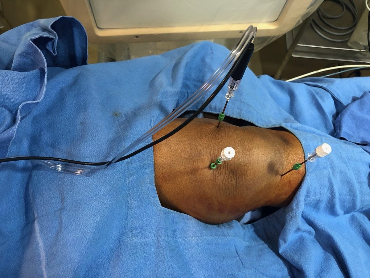 Knee Joint Cooled RFA procedure