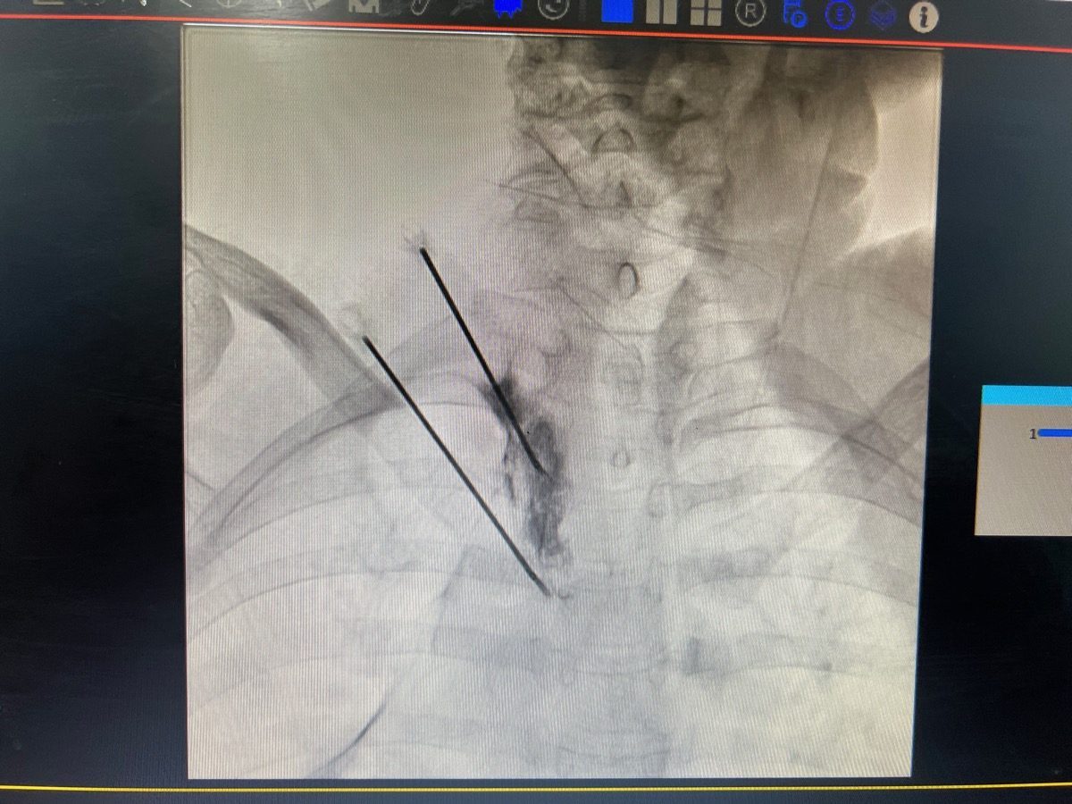 Sympathectomy procedure