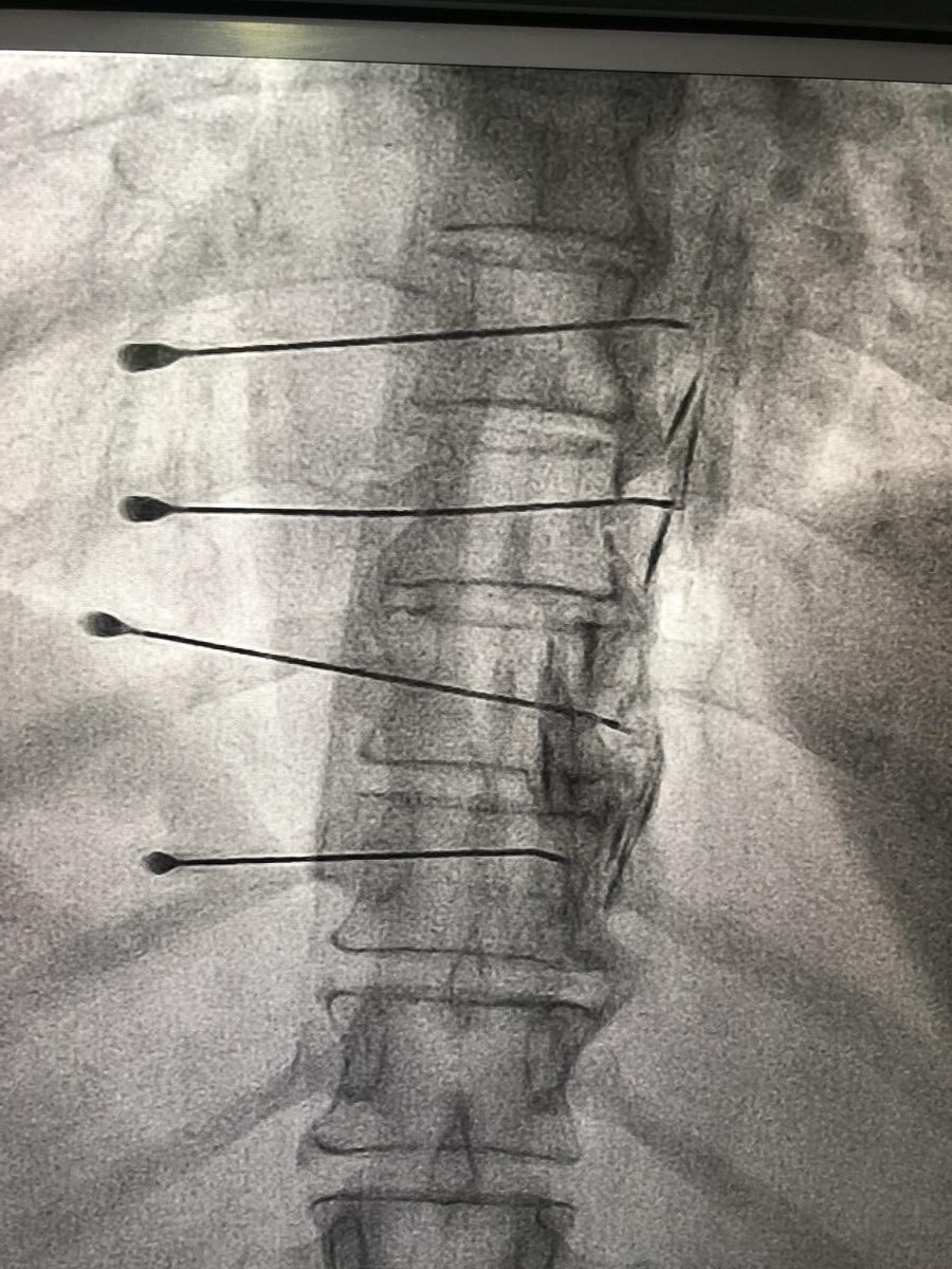 Doctor performing a thoracic injection procedure
