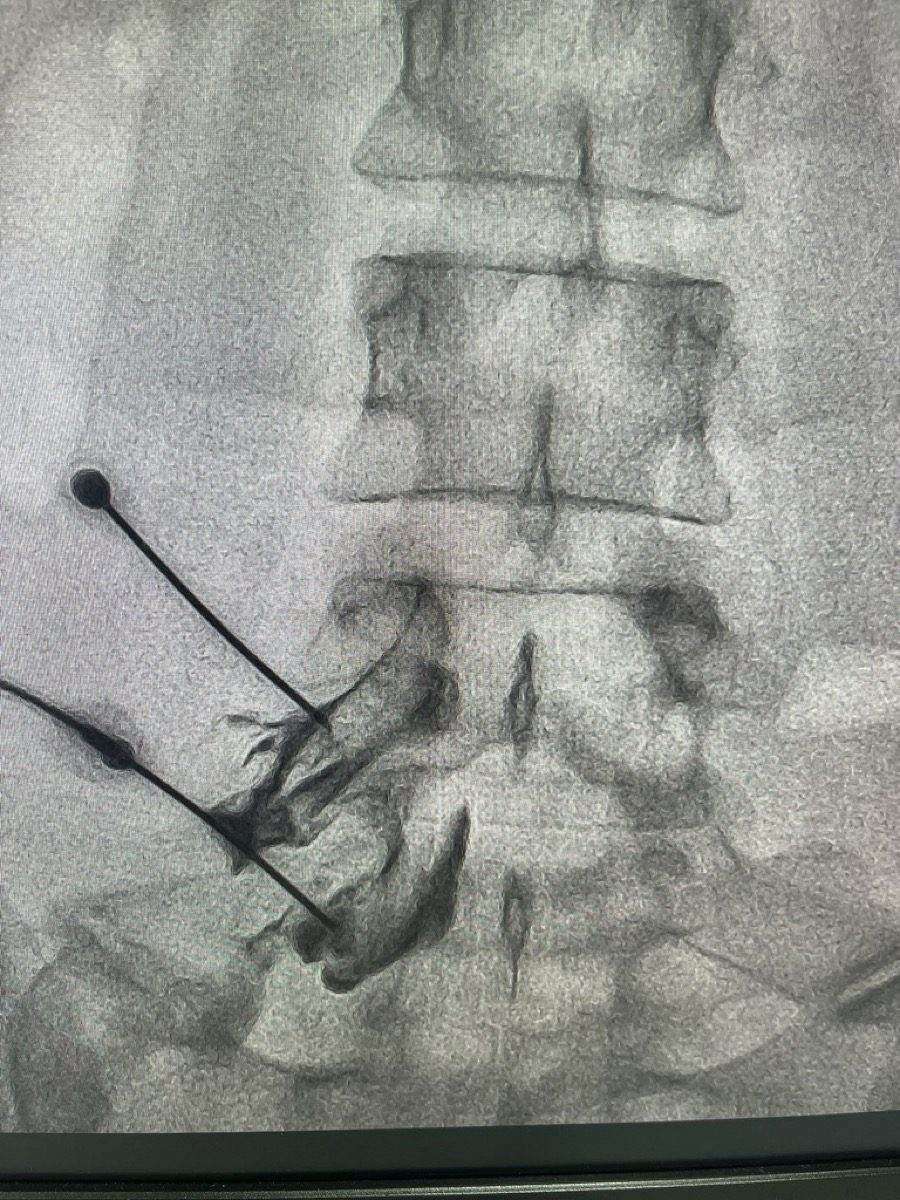 Doctor performing epidural steroid injection procedure